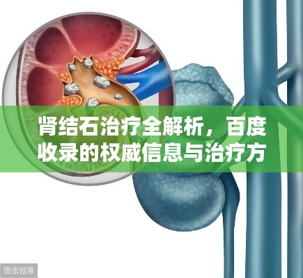 肾结石治疗全解析，百度收录的权威信息与治疗方案